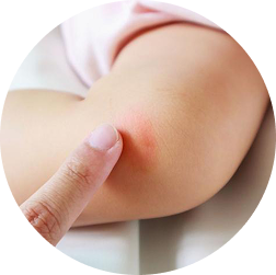 Hỗ trợ làm nhẹ vết cắn côn trùng, vết trầy xước nhỏ